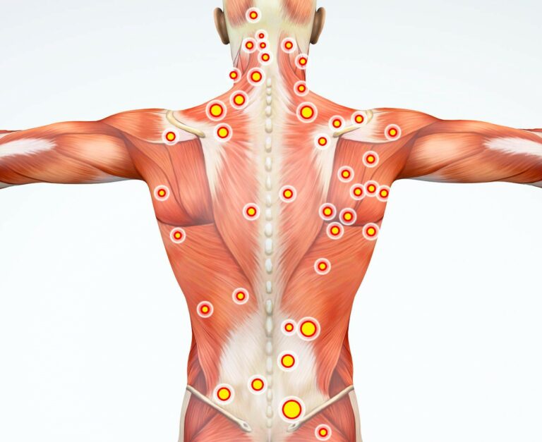 5 Effective Ways to Treat Muscle Knots in Your Back
